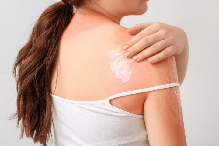 Sử dụng kem chống nắng hợp với da loại mụn lưng 