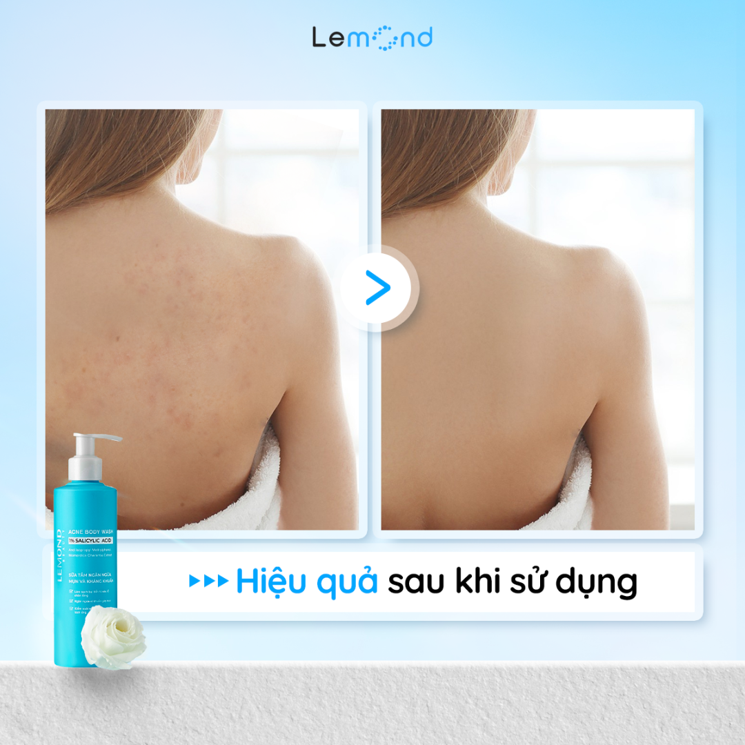 Sữa tắm giảm mụn lưng Lemond Acne Body Wash 250ml