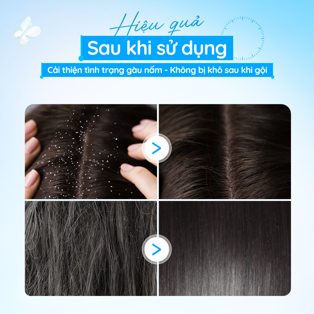 Dầu gội sạch gàu Lemond Antidandruff Shampoo 120ml