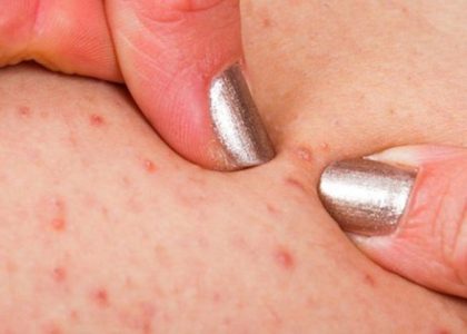 Những cách trị viêm lỗ chân lông hiệu quả nhất