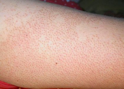 Tips điều trị chân bị viêm nang lông hiệu quả