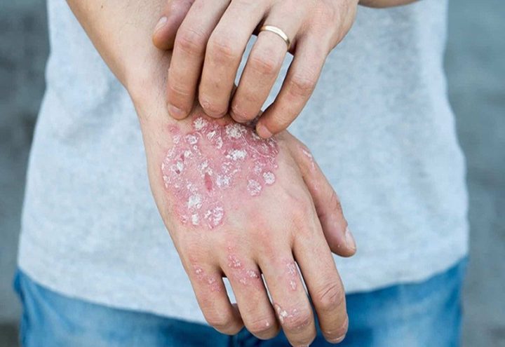 Có nhiều nguyên nhân gây nên bệnh Eczema