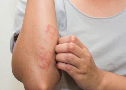 Bệnh Eczema là bệnh gì có chữa được không?