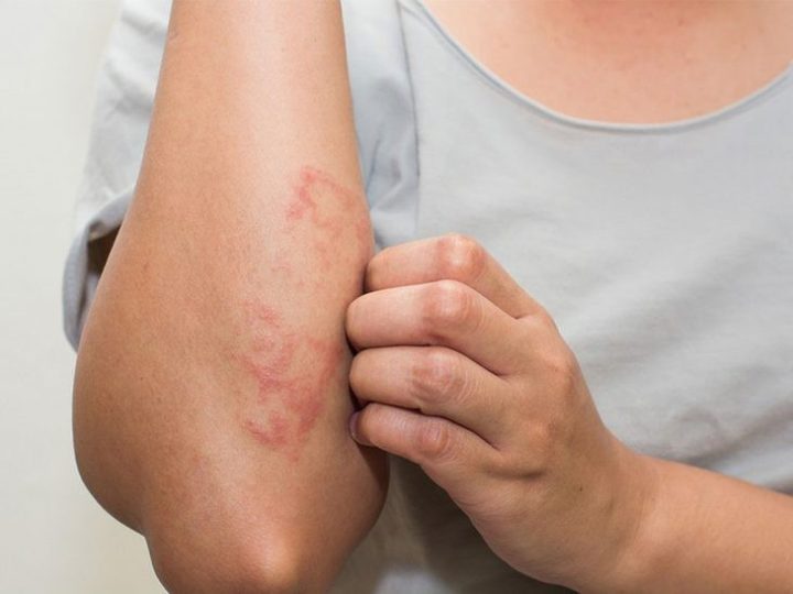 Cách điều trị bệnh eczema