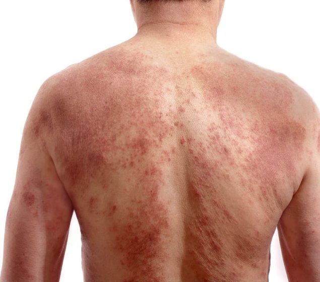 Bệnh Eczema có thể điều trị bằng thuốc uống