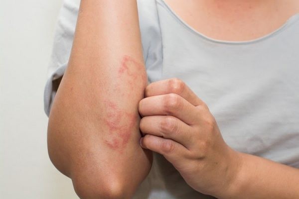 Cần phải có biện pháp phòng ngừa chàm eczema