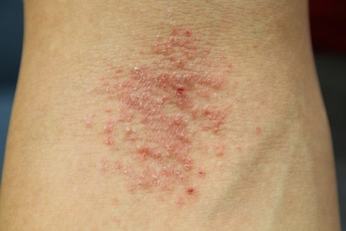 Eczema có thể điều trị bằng mẹo