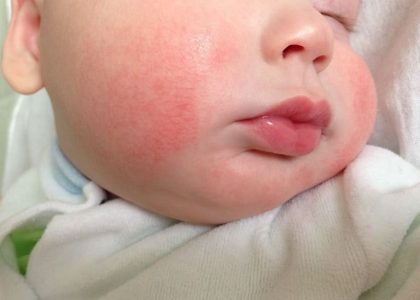 Trẻ sơ sinh bị viêm da cơ địa nguyên nhân và cách điều trị